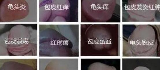 为什么老公一碰我就有霉菌，你老公有gui头炎(一定要夫妻同治)