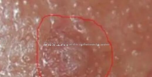 女性菜花状疣初期图片早期图片，淡红色丘疹增大不痒痛(粉/污灰色)