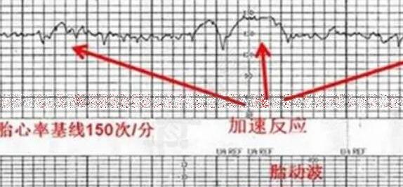 太准了!胎心看男女，5次低于140生男孩几率大(低于110有危险)